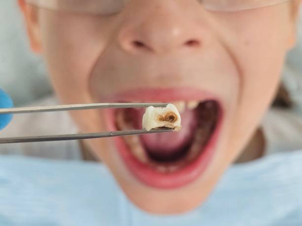 Best Emergency Broken Tooth Repair in Rexland Acres, CA